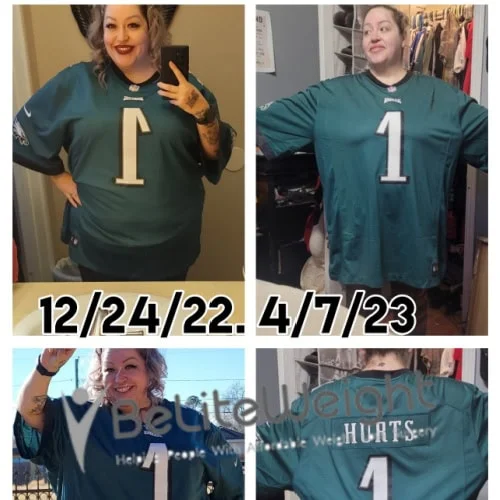 Weight Loss Surgery Gastric Sleeve before and after